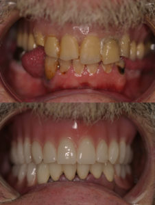 full mouth reconstruction