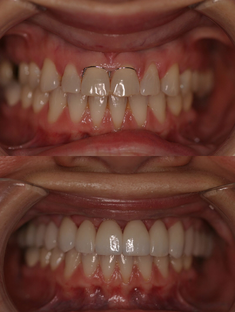 gum recontouring before & after