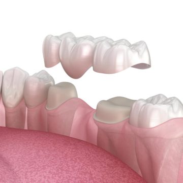 dental bridge illustration