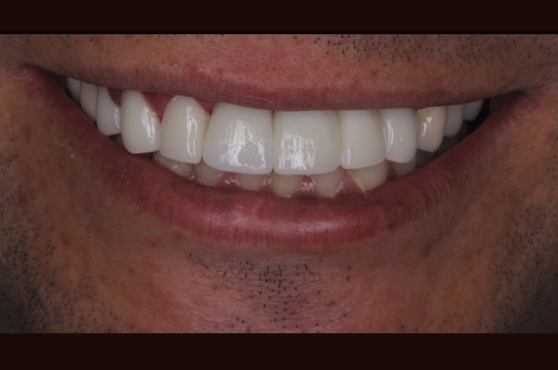 After Full Mouth Reconstruction