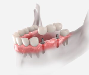 implant bridge