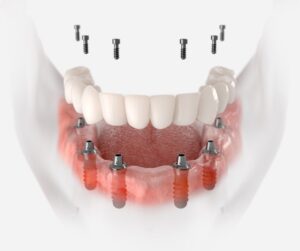 implant dentures