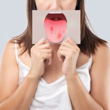 oral cancer tongue